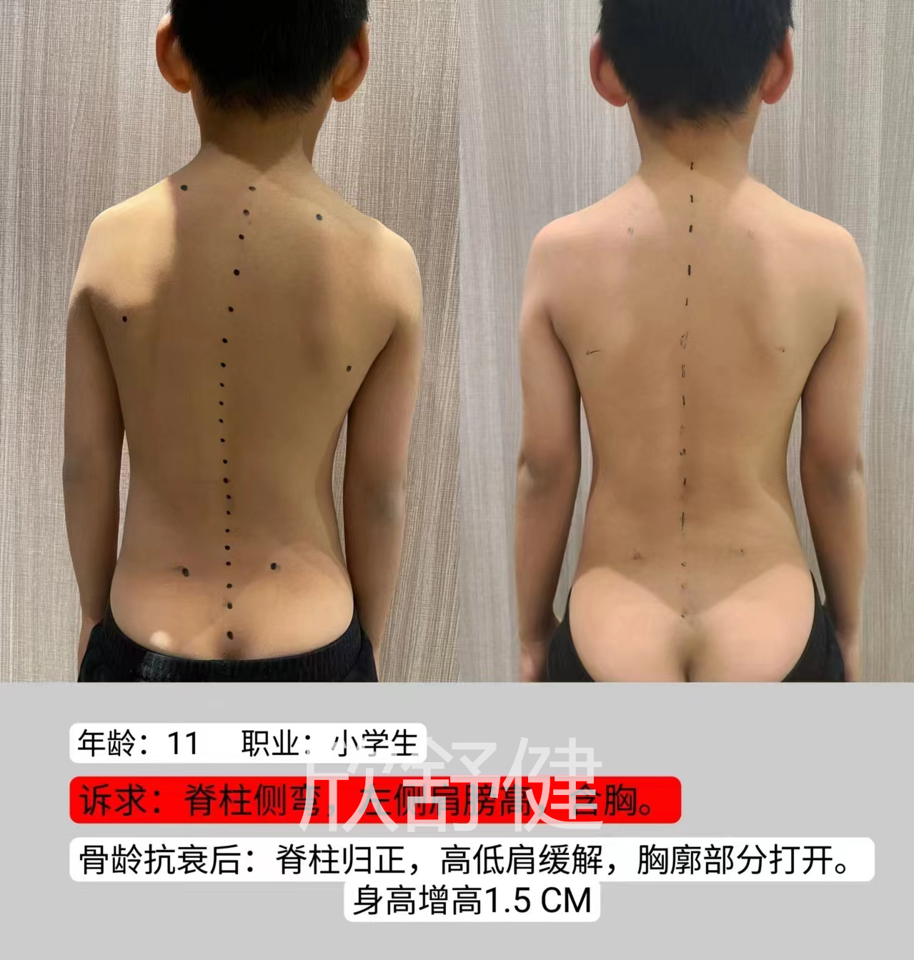 青少年整脊