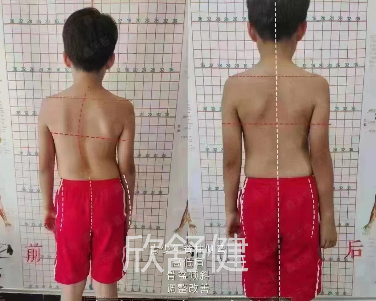 青少年整脊3