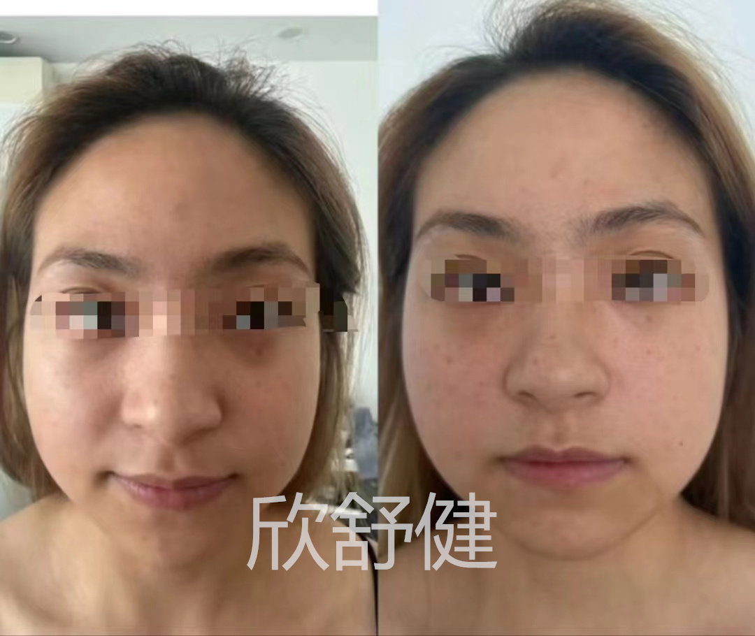 徒手整型2