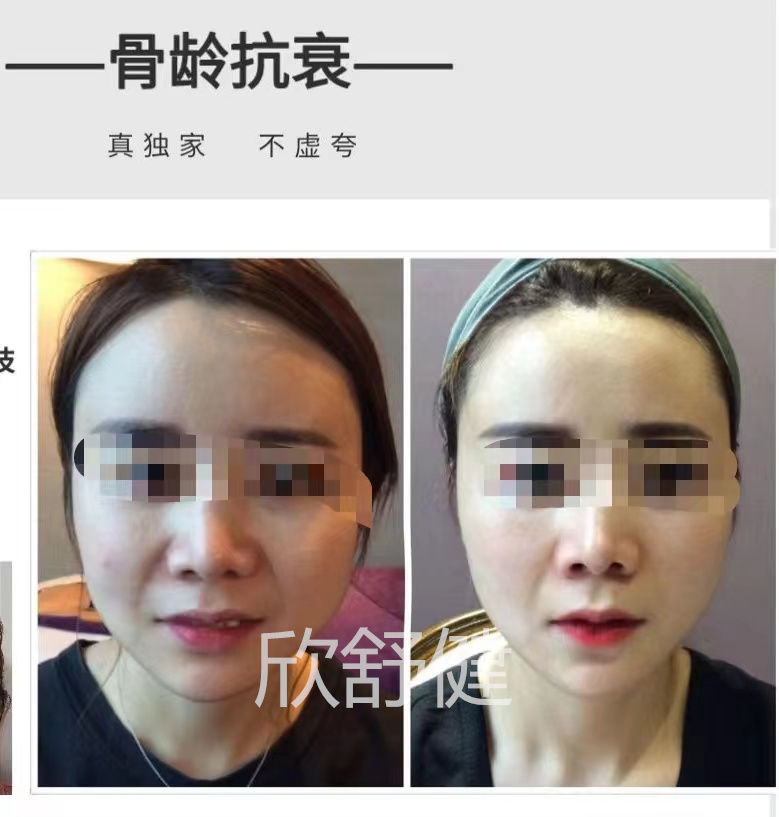 徒手整型4