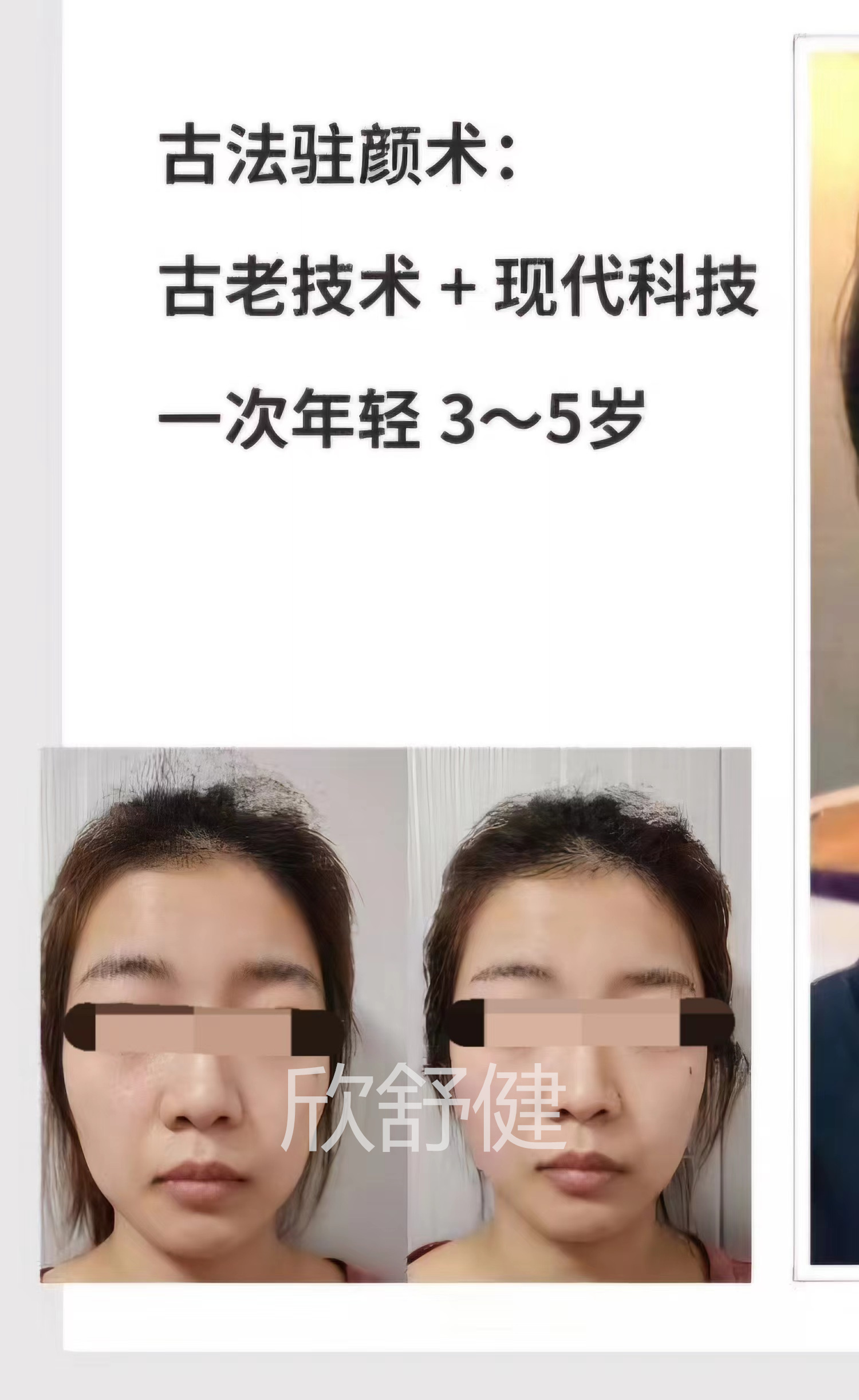 徒手整形