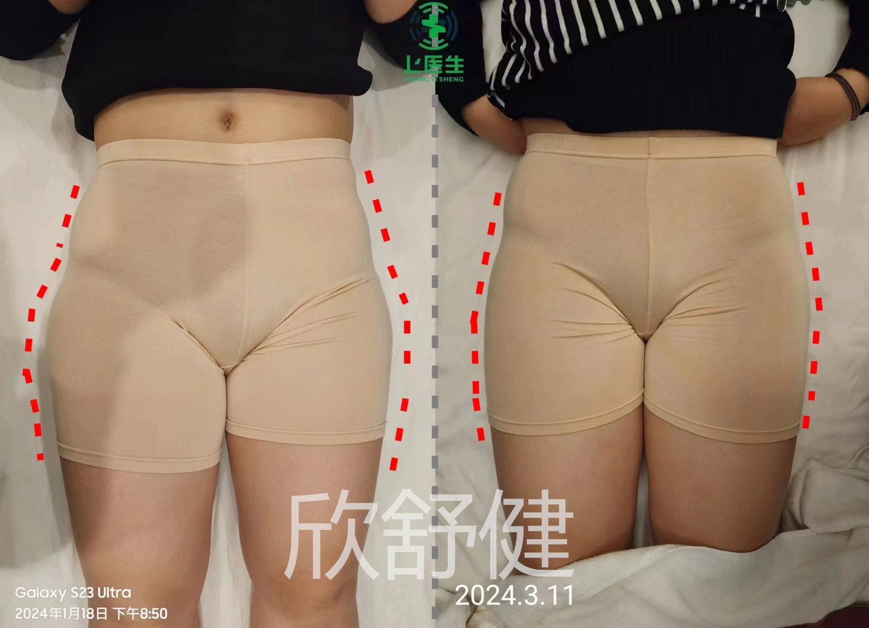 骨盆修复案例3